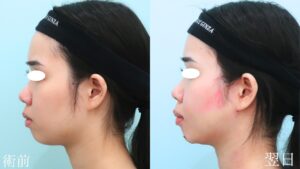 『『BMI16』痩せているのに脂肪吸引?』の画像