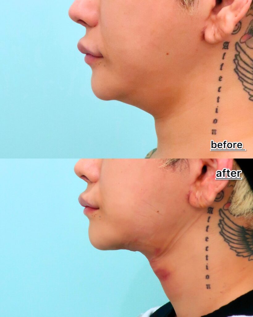 『ペリカン手術とは？脂肪吸引では取り切れない顎下の脂肪に効く！』の画像