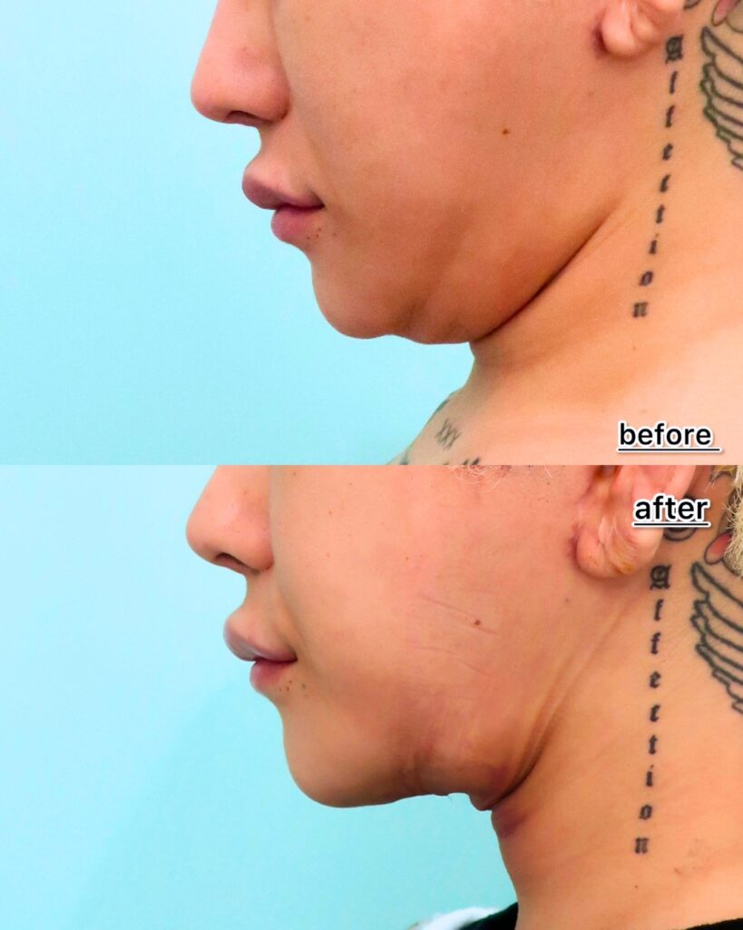 『ペリカン手術とは？脂肪吸引では取り切れない顎下の脂肪に効く！』の画像