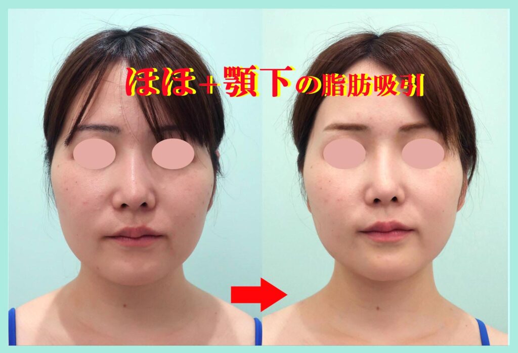 『こんなに綺麗なフェイスラインになる、私の「頬+顎下」のベイザー脂肪吸引』の画像