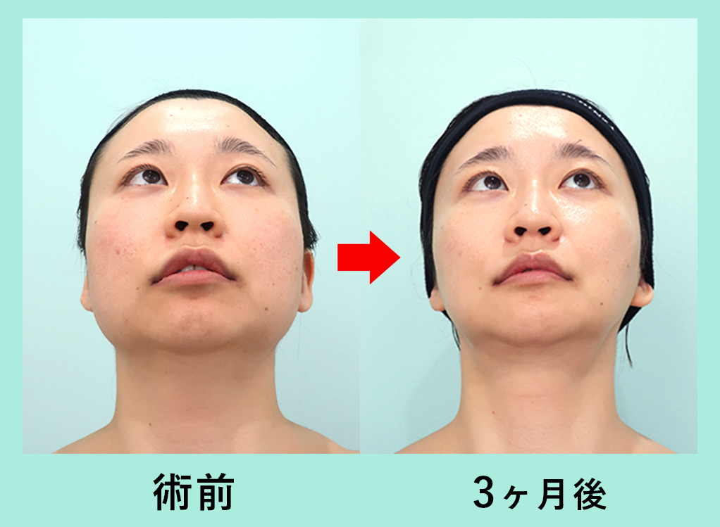 『輪郭3点骨切り× 脂肪吸引で圧倒的変化を!』の画像