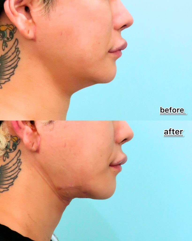 『ペリカン手術とは？脂肪吸引では取り切れない顎下の脂肪に効く！』の画像