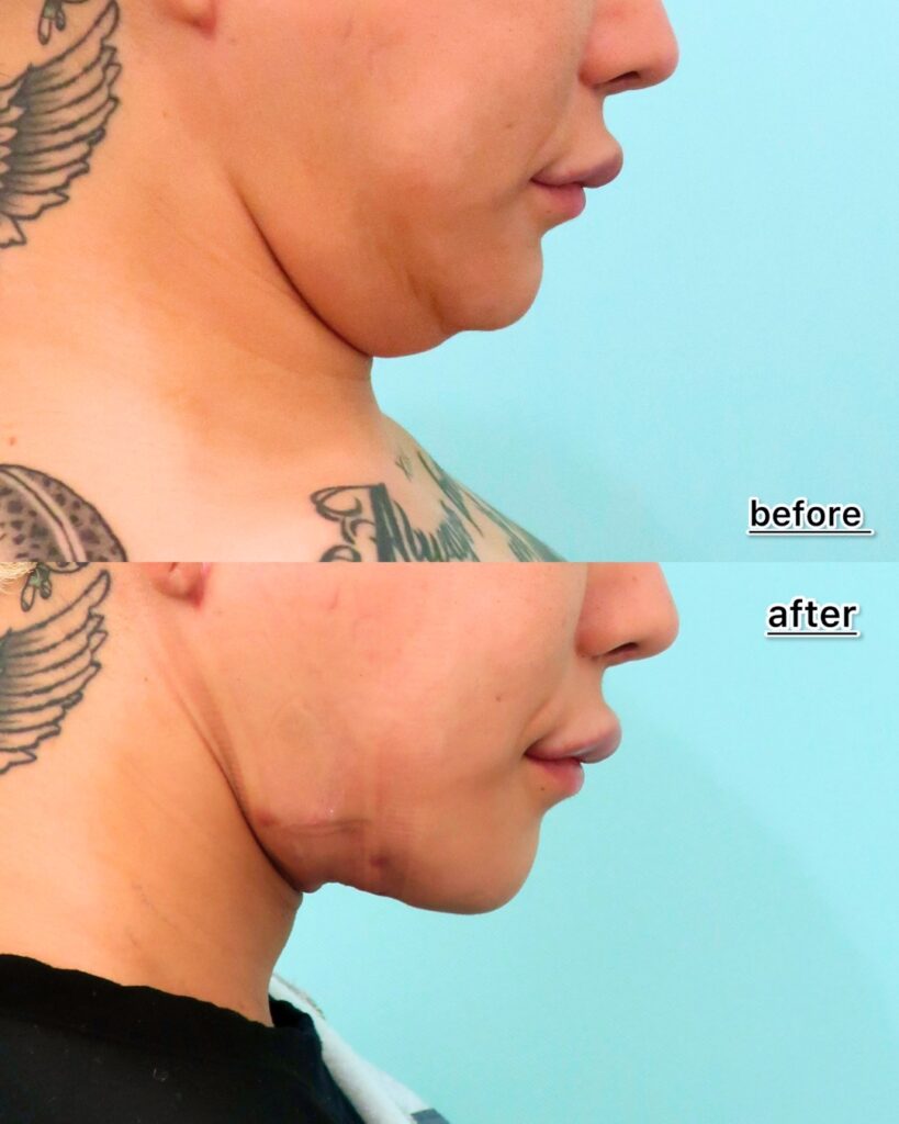 『ペリカン手術とは？脂肪吸引では取り切れない顎下の脂肪に効く！』の画像