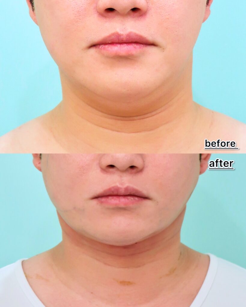 『脂肪吸引で取れない顎下のたるみ。ペリカン手術・ネックリフトで劇的改善！』の画像