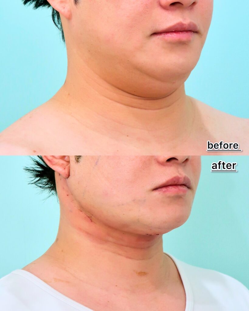 『脂肪吸引で取れない顎下のたるみ。ペリカン手術・ネックリフトで劇的改善！』の画像