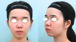 『『BMI16』痩せているのに脂肪吸引?』の画像