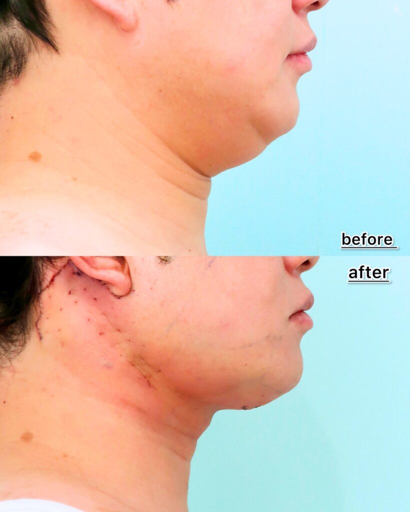 『脂肪吸引で取れない顎下のたるみ。ペリカン手術・ネックリフトで劇的改善！』の画像