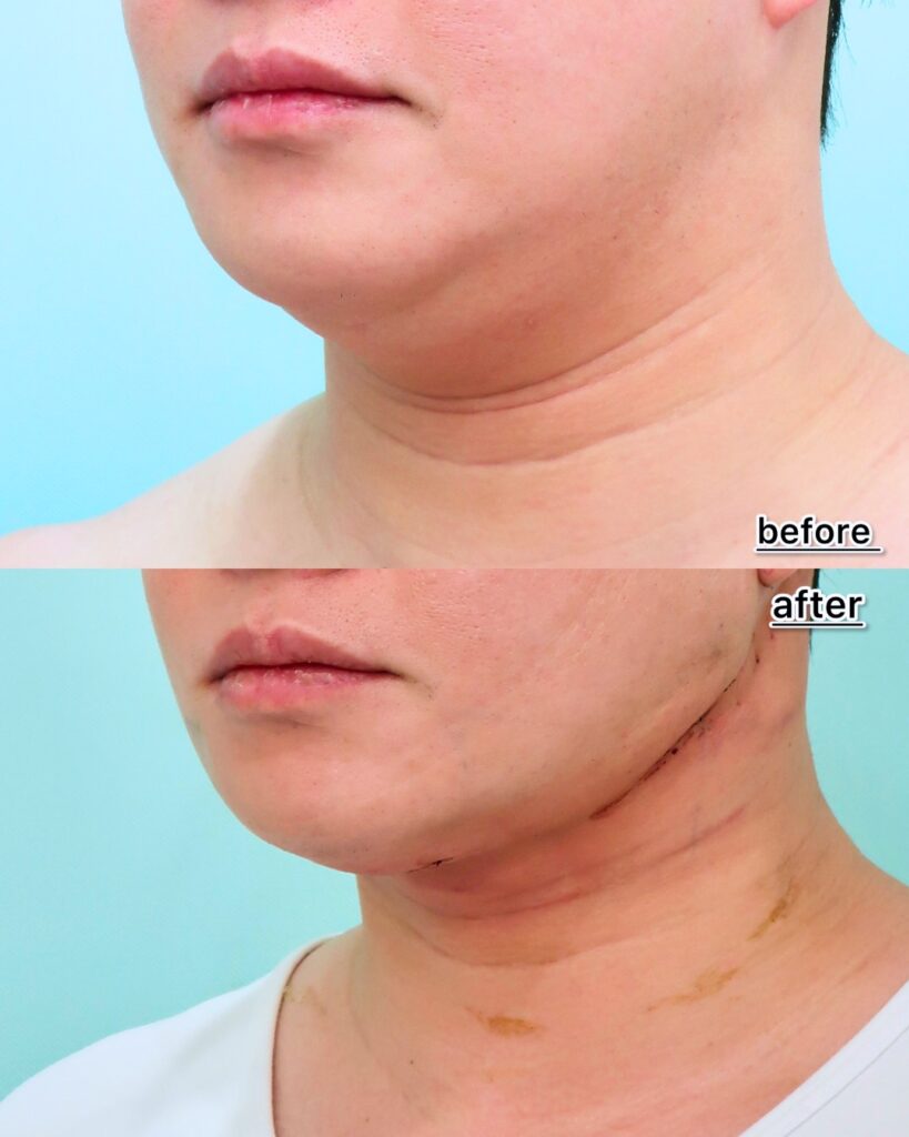 『脂肪吸引で取れない顎下のたるみ。ペリカン手術・ネックリフトで劇的改善！』の画像