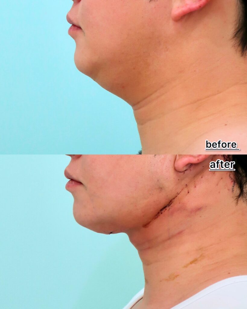 『脂肪吸引で取れない顎下のたるみ。ペリカン手術・ネックリフトで劇的改善！』の画像