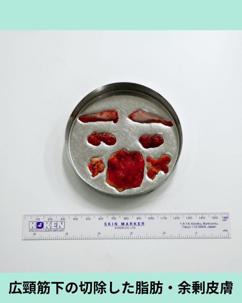 『脂肪吸引で取れない顎下のたるみ。ペリカン手術・ネックリフトで劇的改善！』の画像