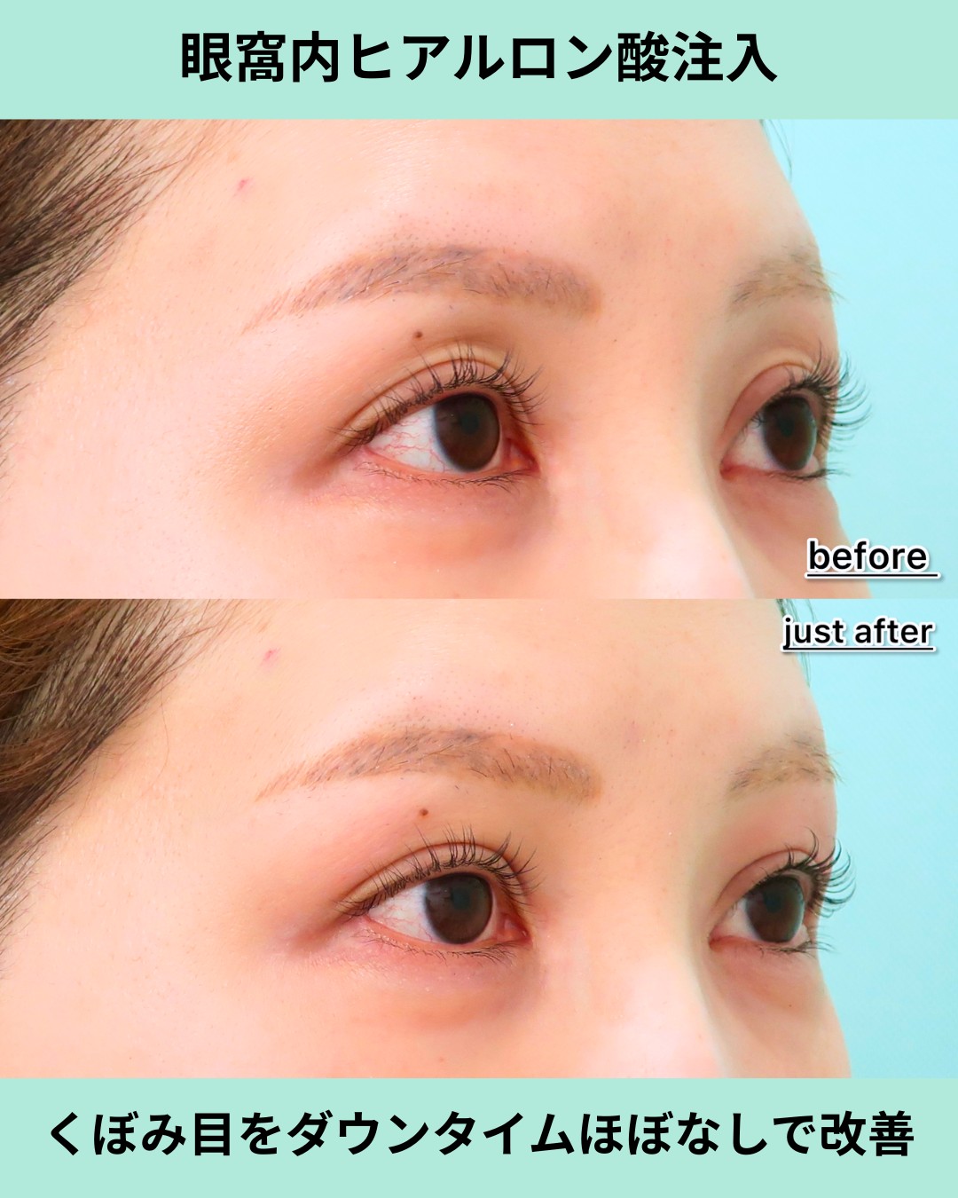 21460クラシマヒカル