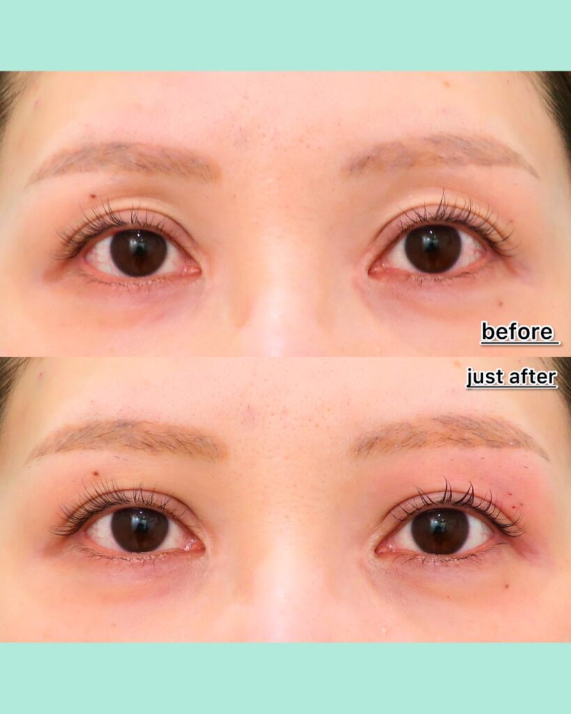 『老け見えを改善！眼窩内ヒアルロン酸でくぼみ目を解消』の画像