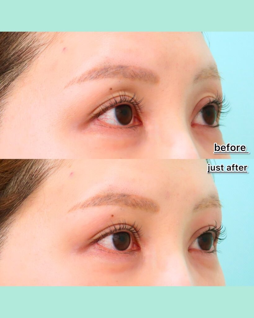 『老け見えを改善！眼窩内ヒアルロン酸でくぼみ目を解消』の画像