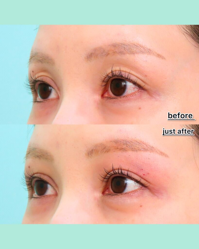 『老け見えを改善！眼窩内ヒアルロン酸でくぼみ目を解消』の画像