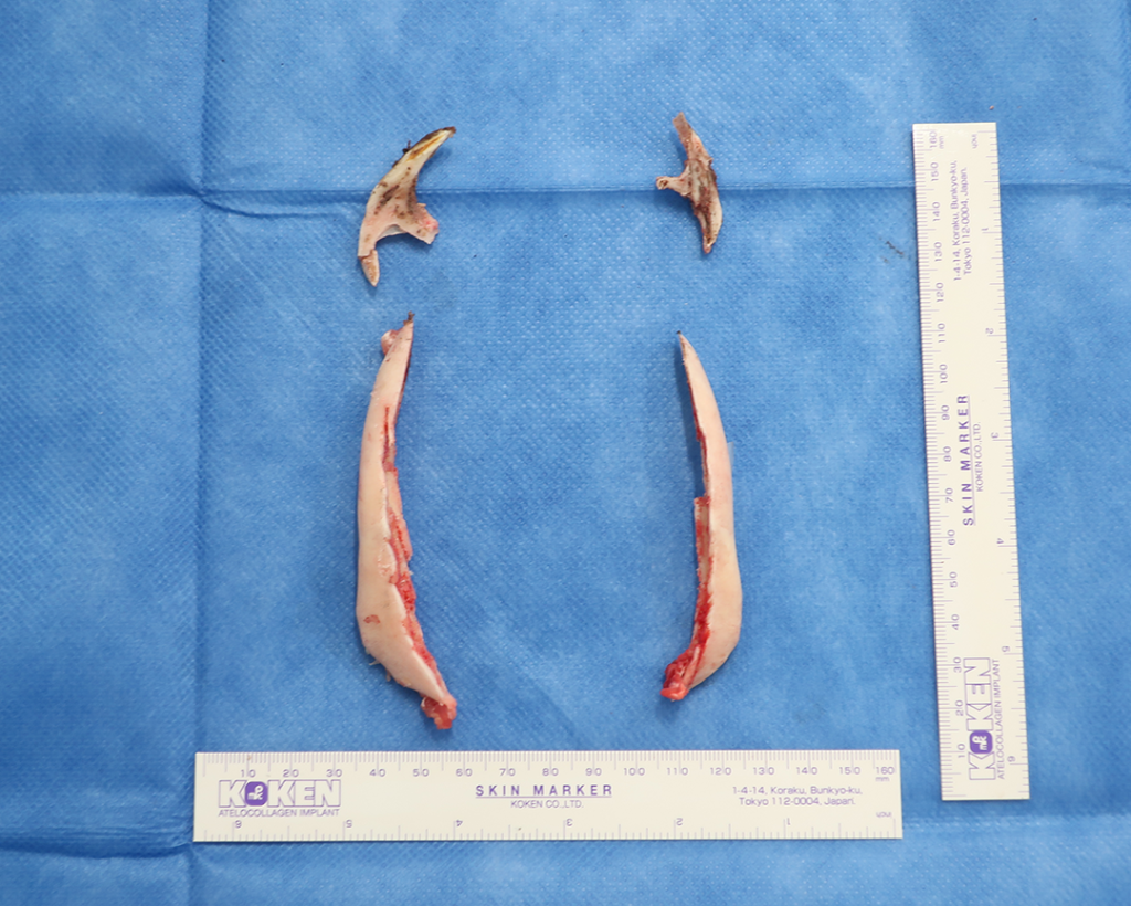 『圧倒的変化量!輪郭3点+脂肪吸引』の画像