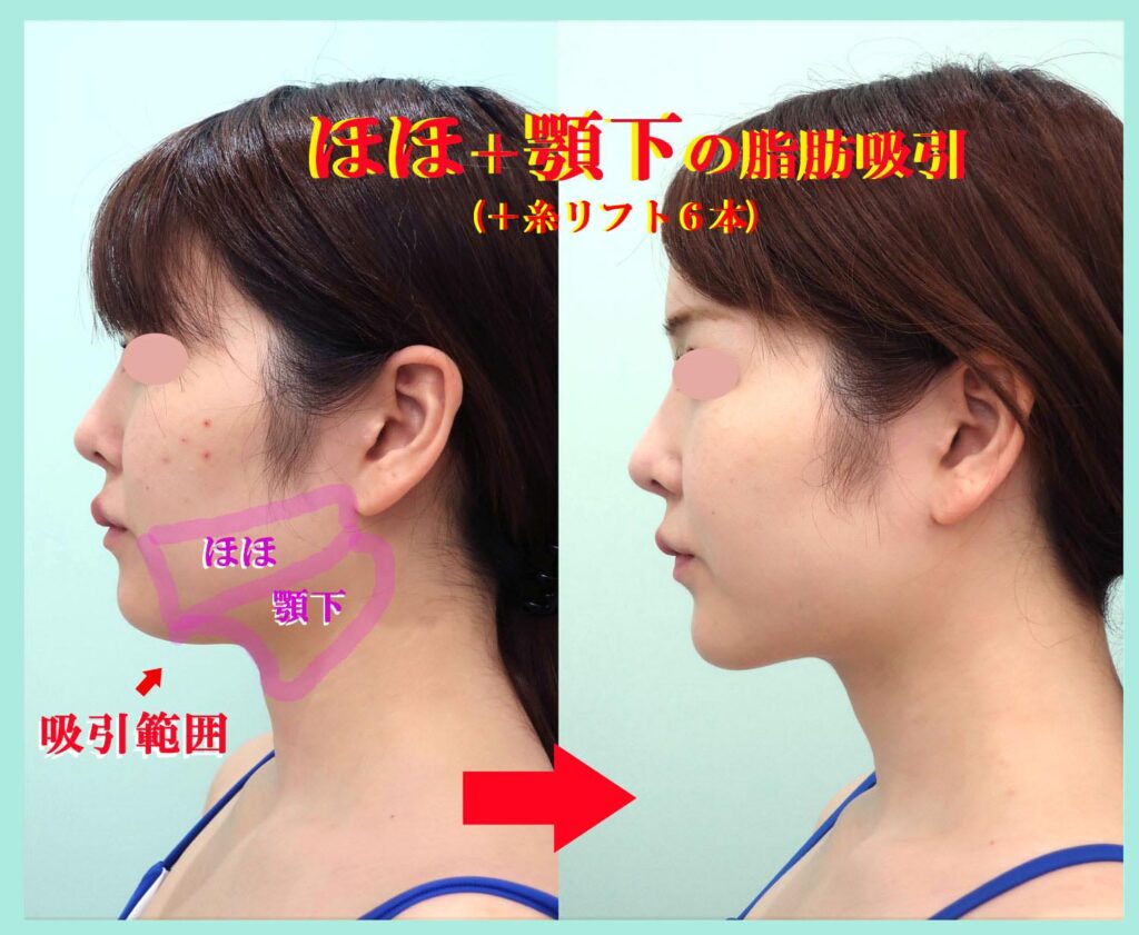 『こんなに綺麗なフェイスラインになる、私の「頬+顎下」のベイザー脂肪吸引』の画像
