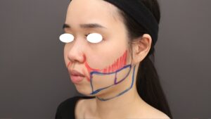 『『BMI16』痩せているのに脂肪吸引?』の画像