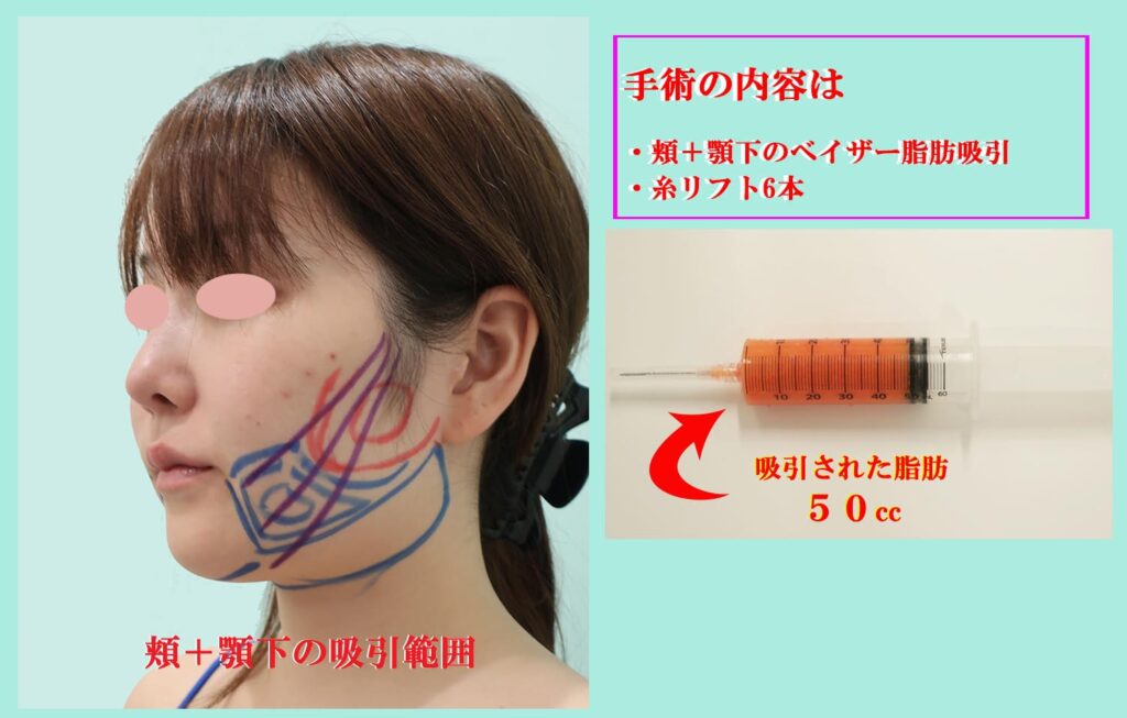 『美しいフェイスラインになる、私の「頬+顎下」のベイザー脂肪吸引法』の画像