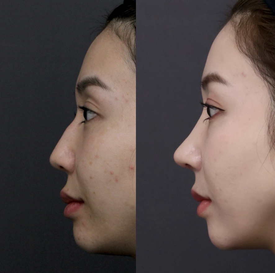 『骨切り × 自家組織 × 中顔面立体化で、顔全体の印象を一段引き上げる鼻整形』の画像