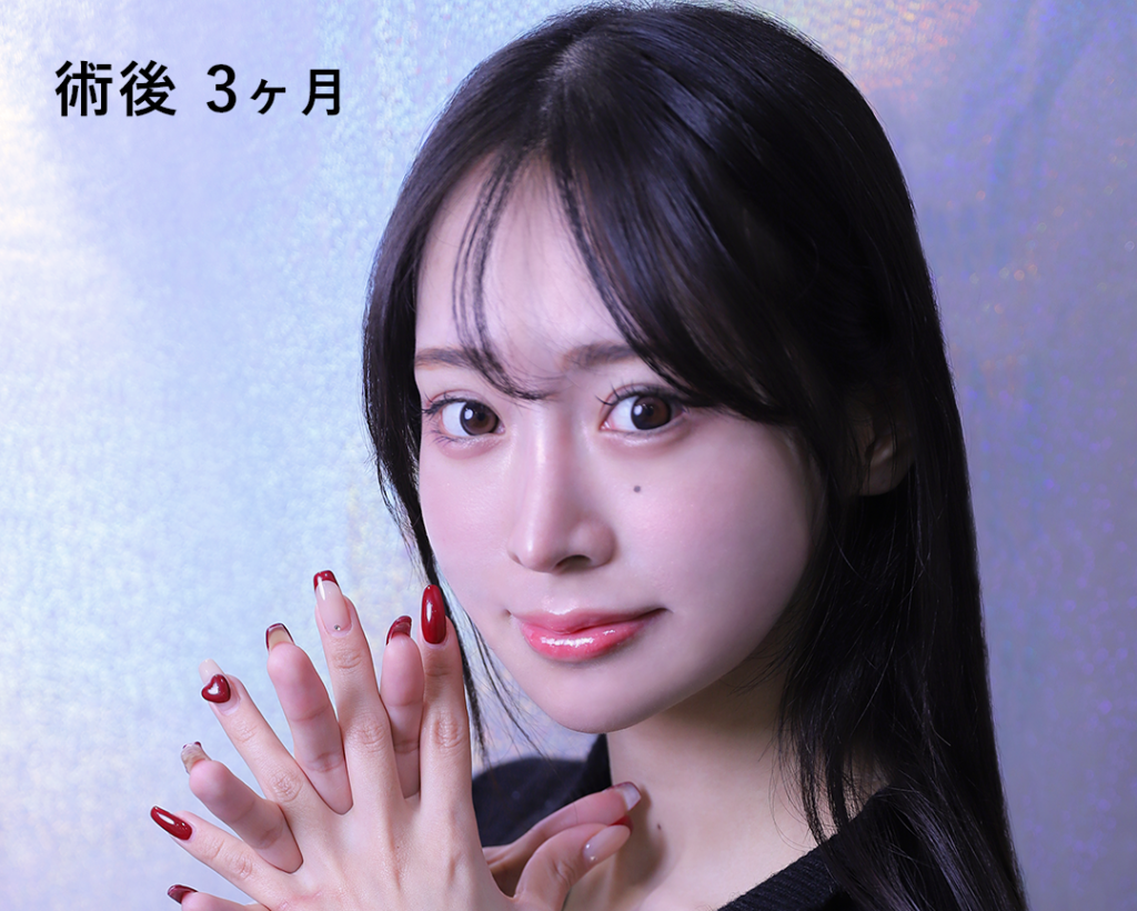 『圧倒的変化量!輪郭3点+脂肪吸引』の画像