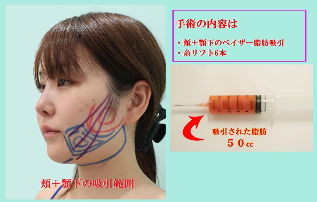 『こんなに綺麗なフェイスラインになる、私の「頬+顎下」のベイザー脂肪吸引』の画像