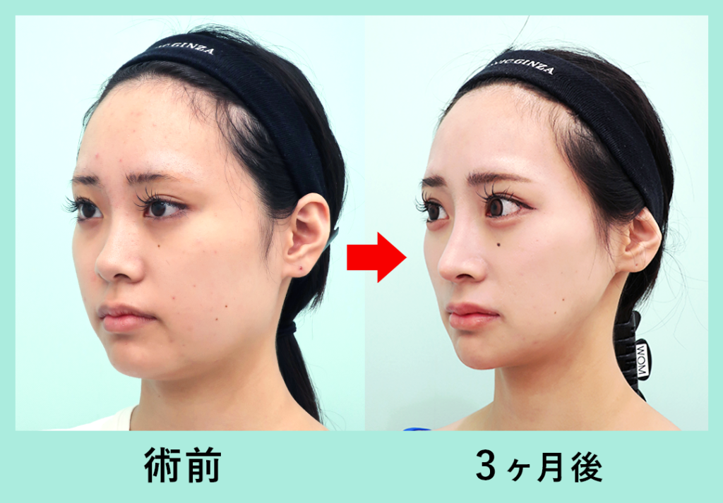 『圧倒的変化量!輪郭3点+脂肪吸引』の画像