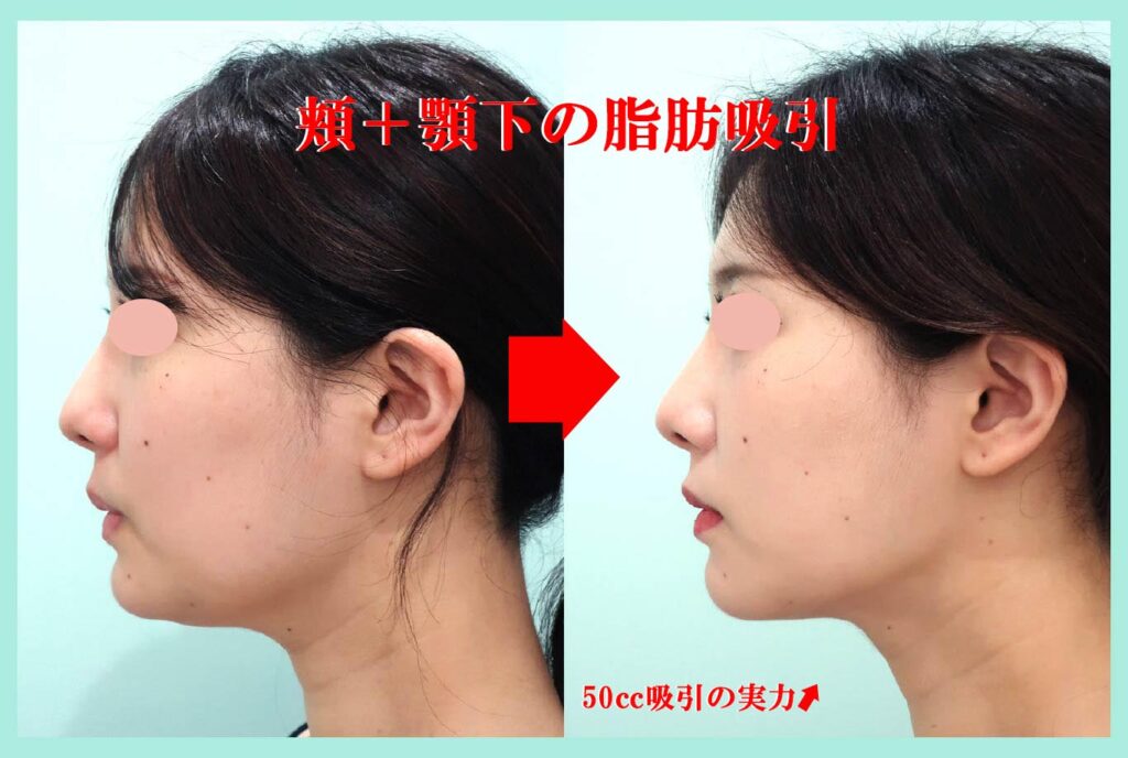 小顔吸引手術側面写真