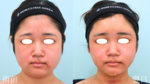 『『小顔/輪郭形成』上・下顔面へのトータルアプローチで理想の輪郭に。』の画像