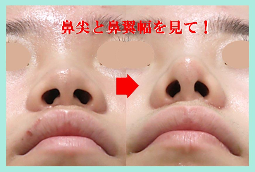 『鼻翼幅を筋膜移植で縮小・固定する当院オリジナルの「 忘れ鼻 」作成術( 鼻翼間縮小・固定術 )』の画像