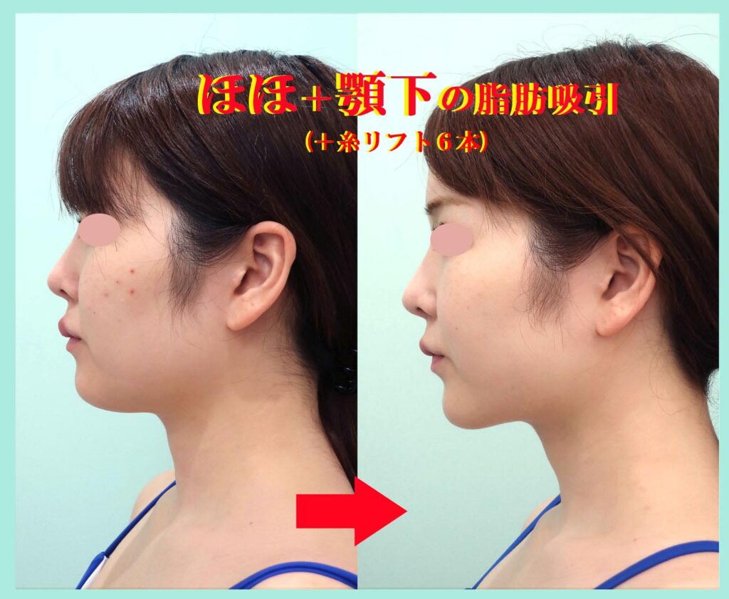 『こんなに綺麗なフェイスラインになる、私の「頬+顎下」のベイザー脂肪吸引』の画像