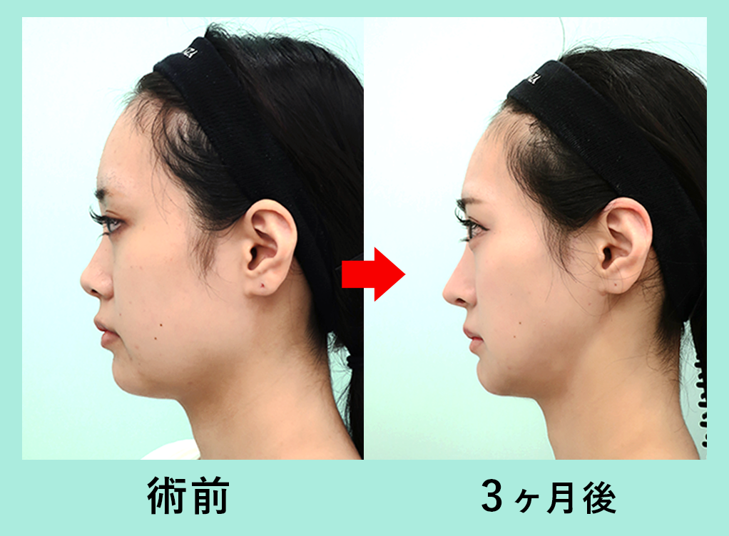 『圧倒的変化量!輪郭3点+脂肪吸引』の画像