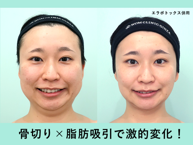 輪郭3点、チタンプレート、頬顎、バッカル、エラBTX100、ベイザー　