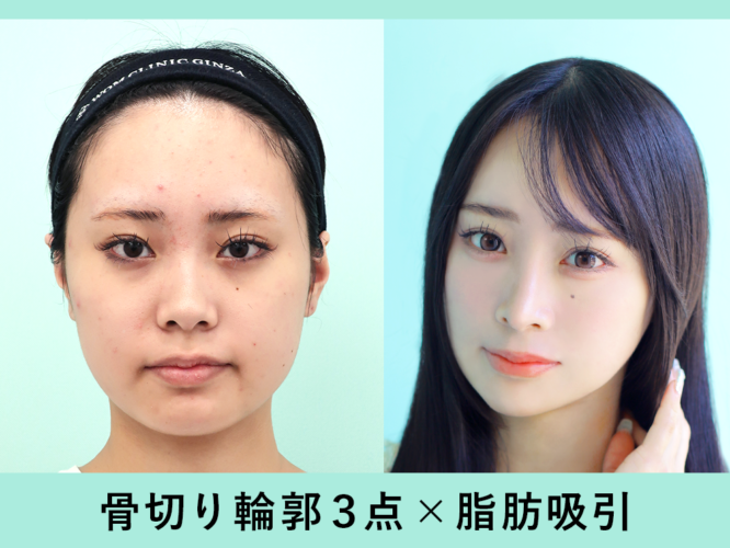 頬骨骨切り、チタンプレート、下顎外板切除、Vライン形成、T字骨切り前進、チタンプレート、頬顎、ジョール、バッカル、エラBTX（100U）、糸リフト10本