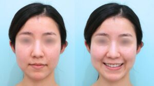 『左右差の目立つ口横のポニョ、その原因は？』の画像