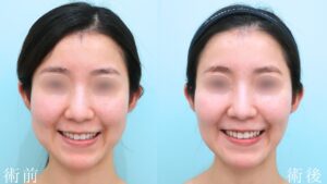 『左右差の目立つ口横のポニョ、その原因は？』の画像