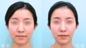 『左右差の目立つ口横のポニョ、その原因は？』の画像