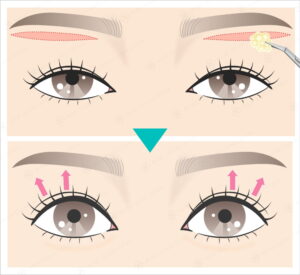 ROOF施術後の比較