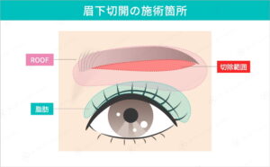 眉下切開の施術箇所を示すイラスト