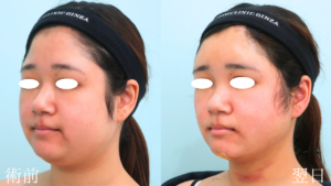 『『小顔/輪郭形成』上・下顔面へのトータルアプローチで理想の輪郭に。』の画像