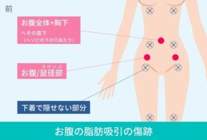 腹部の脂肪吸引の傷跡の位置