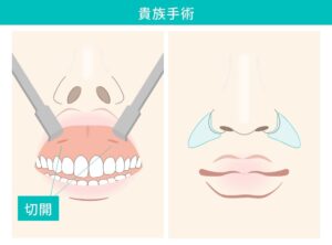 貴族手術の術後の変化