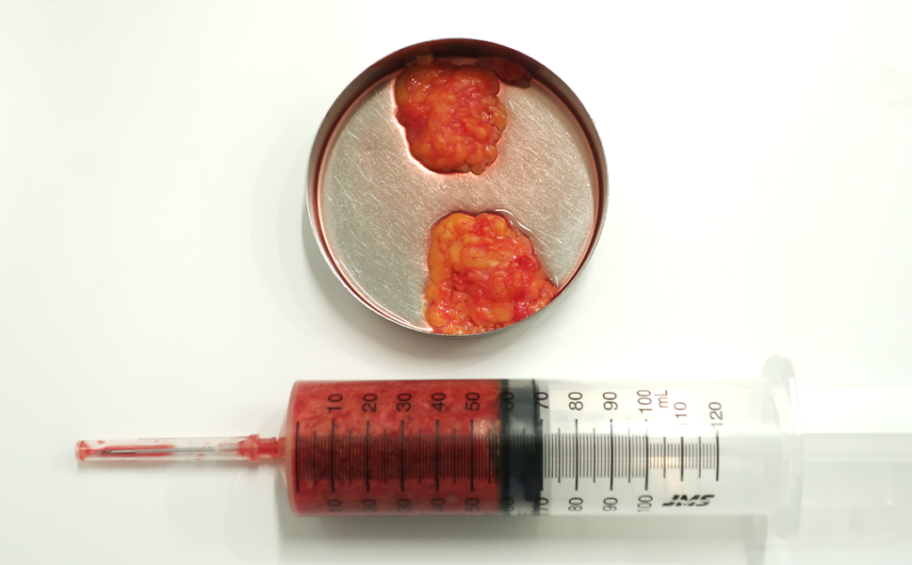 『輪郭3点骨切り× 脂肪吸引で圧倒的変化を!』の画像