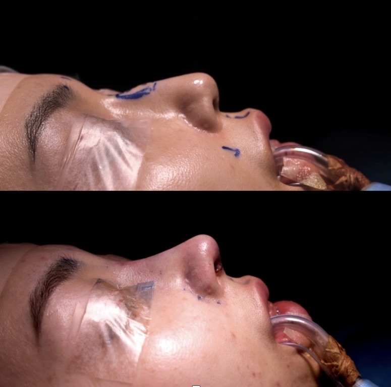 『骨切り × 自家組織 × 中顔面立体化で、顔全体の印象を一段引き上げる鼻整形』の画像