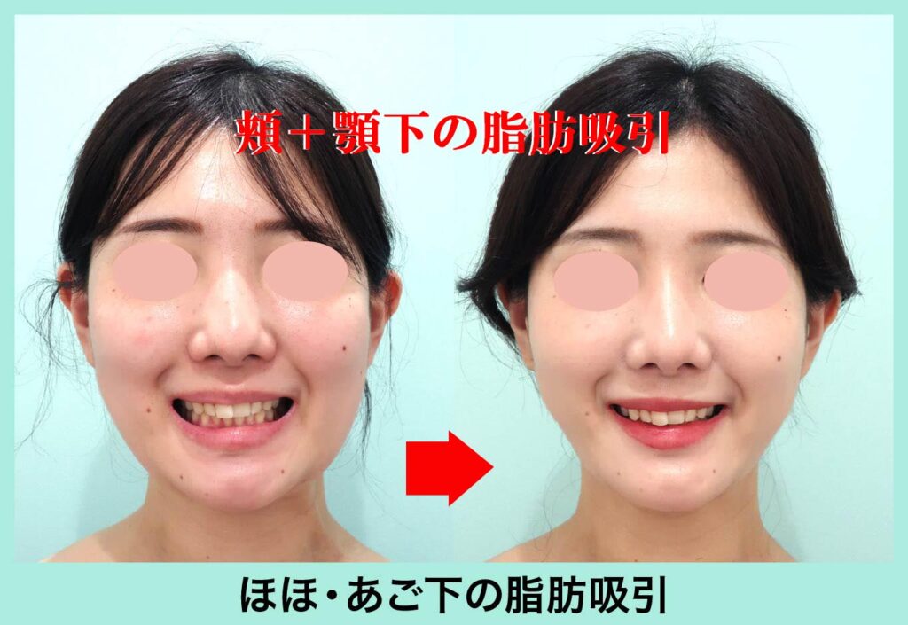 小顔吸引手術後正面写真