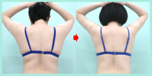 背中のビフォーアフター比較