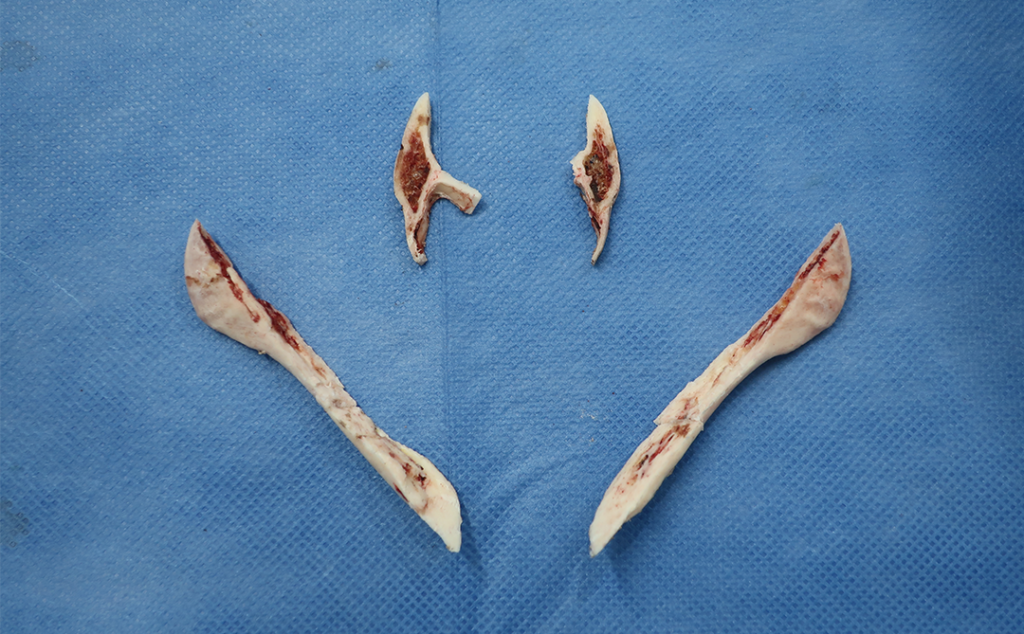 『輪郭3点骨切り× 脂肪吸引で圧倒的変化を!』の画像