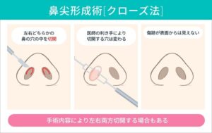鼻尖形成術（クローズ法）の工程図