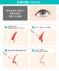 目頭切開PARK法の術式解説図