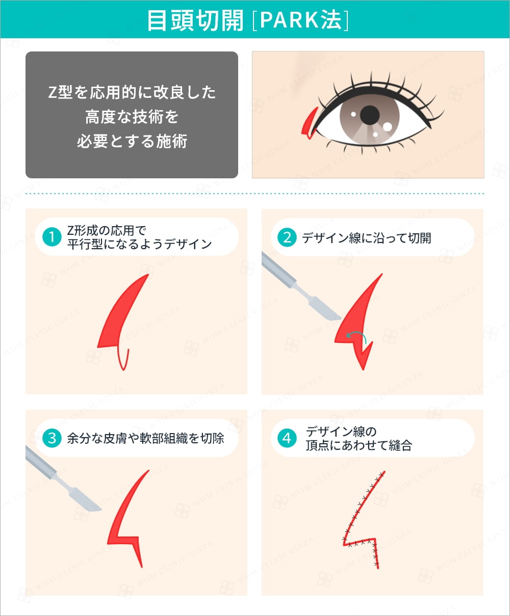 目頭切開PARK法の術式解説図