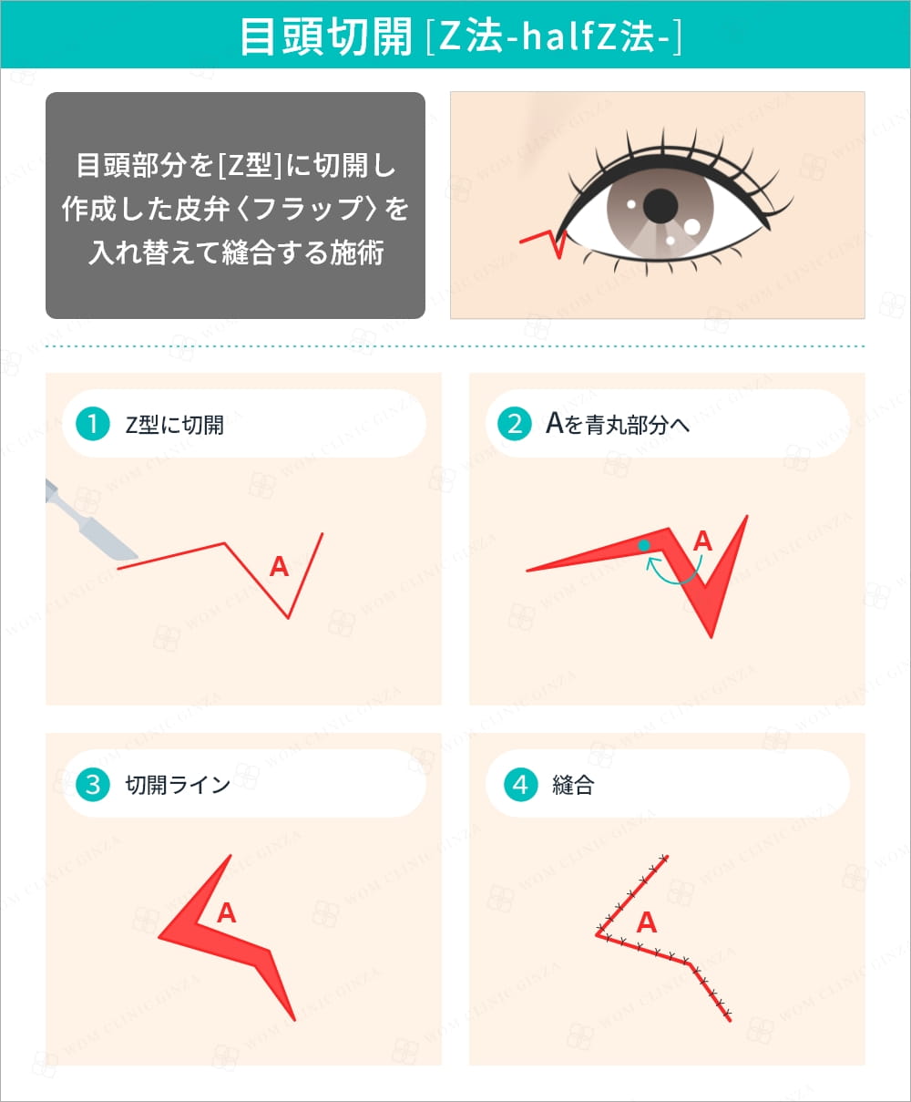 目頭切開のZ法halfZ法の術式図解